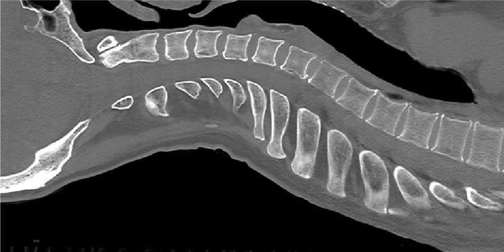 理想的な背骨のアーチを確認するためのCT画像